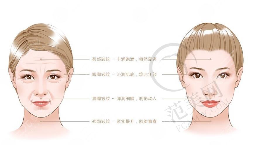激光除皱及射频除皱的区别