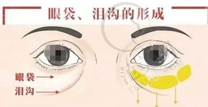 嗨体填充泪沟术