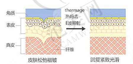 什么是热玛吉?