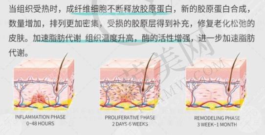 热玛吉和7d聚拉提的区别同在哪里?