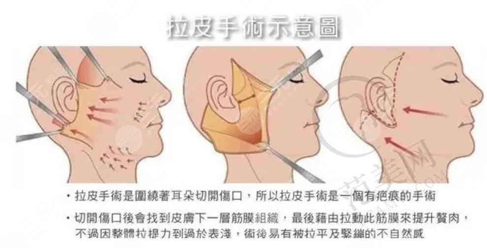 小拉皮手术