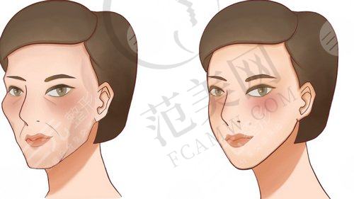 嗨体填充泪沟术