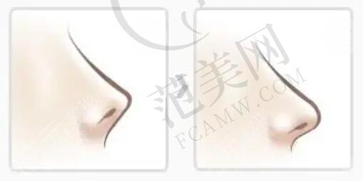 湖南省人民医院隆鼻案例分享