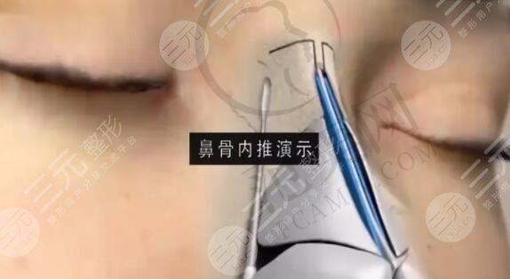 湖南省人民医院隆鼻案例分享