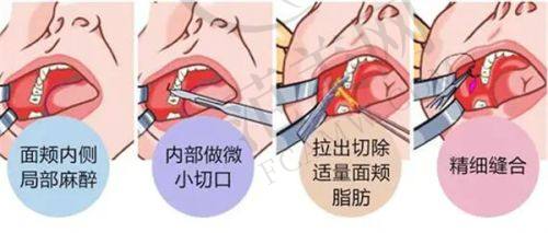 荔湾区人民医院美容科热门项目——双眼皮手术选择
