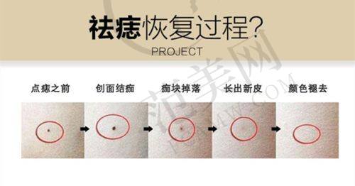二、夏建军医生隆胸实例详情：先天发育不良女孩的自信重塑