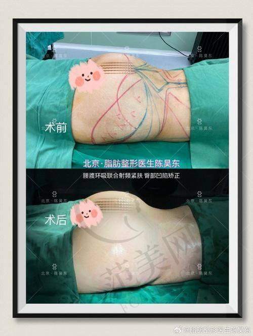 五、杭州彭涛所属医院情况之彭涛医生吸脂价格贵吗