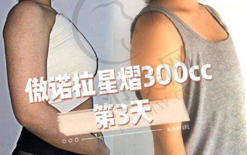 乌鲁木齐伊丽莎白整形美容脂肪胶丰胸58000元起优势具体解析