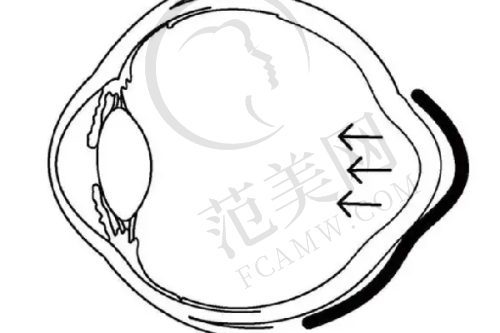 鼻骨内推手术的选择与注意事项