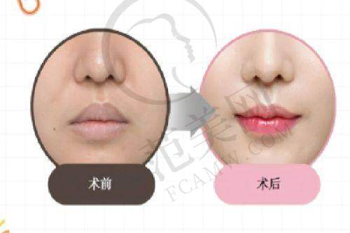 四、西安现代妇产医院美容科，紧缩针优势在哪？