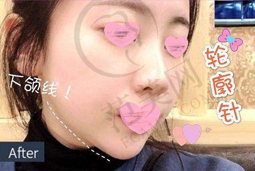 南京耳软骨复合隆鼻十佳排行：南京美贝尔医疗美容医院的技术亮点
