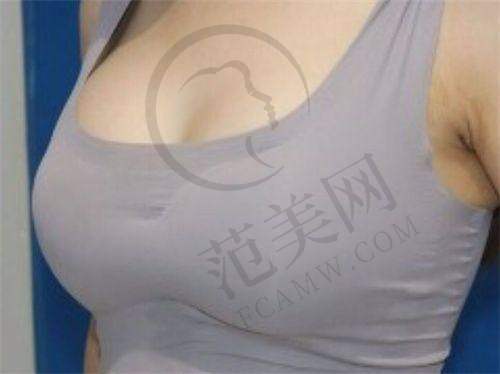 上海假体+自体脂肪丰胸哪家好：上海美莱医疗美容医院