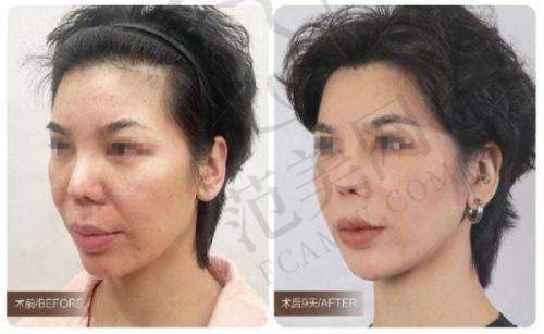 乌鲁木齐伊丽莎白整形美容脂肪胶丰胸58000元起顾客实例展示