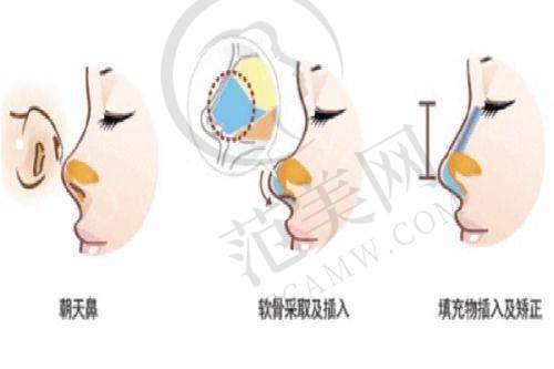 脉冲染料激光治疗的注意事项
