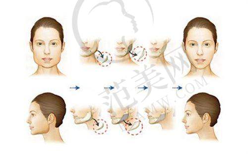 杭州艺星整形双眼皮价格情况之二:特色眼综合手术价格