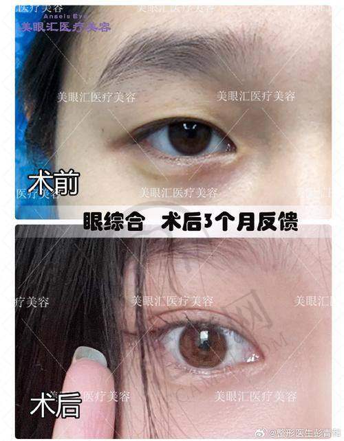 合肥伊尔切开双眼皮18000元起划算吗