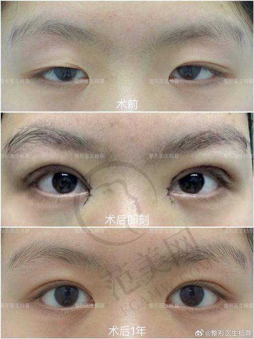 合肥伊尔切开双眼皮18000元起顾客实例