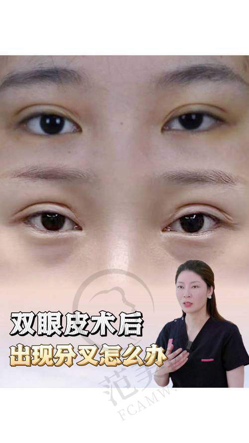 合肥伊尔切开双眼皮18000元起优势详解
