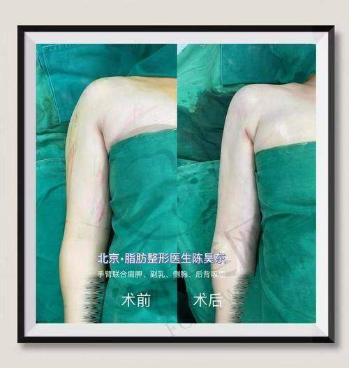 重庆星荣背部吸脂18800元起，朱晓浩威塑3.0技术认证改善虎背熊腰优势详解