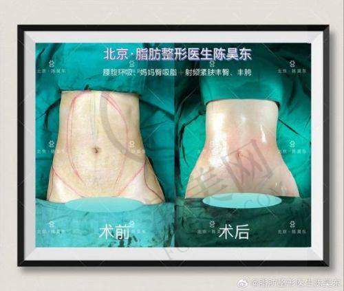 重庆星荣背部吸脂18800元起，朱晓浩威塑3.0技术认证改善虎背熊腰项目简介