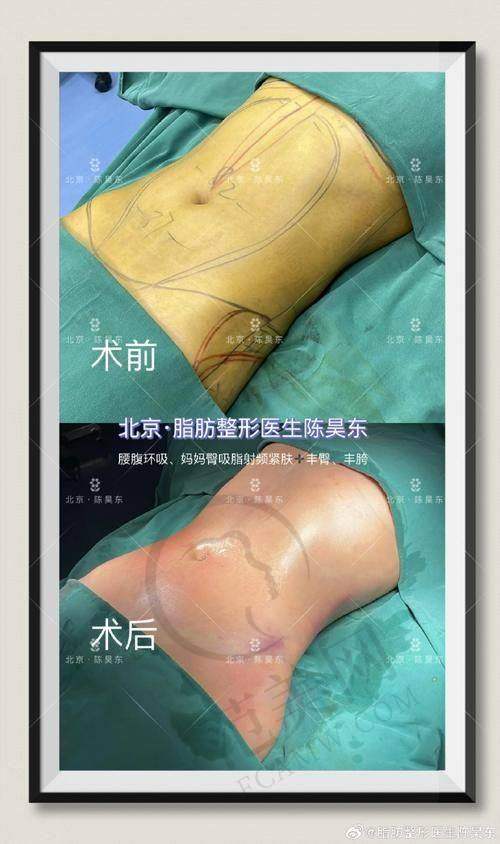重庆星荣背部吸脂18800元起，朱晓浩威塑3.0技术认证改善虎背熊腰医生简介