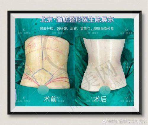重庆星荣背部吸脂18800元起，朱晓浩威塑3.0技术认证改善虎背熊腰是否划算