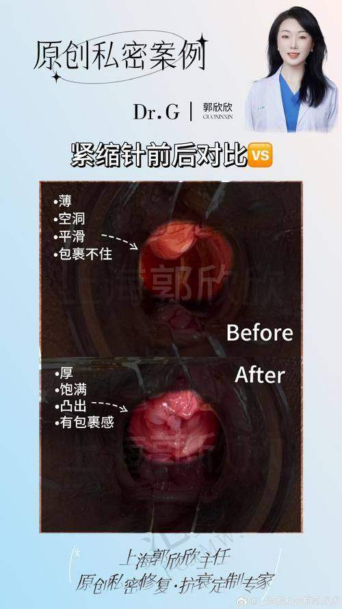 东莞埋线紧缩阴道榜单精选：东莞佰佳整形医院