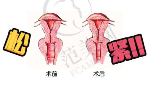 东莞埋线紧缩阴道榜单精选：东莞维多利亚妇儿医院整形科