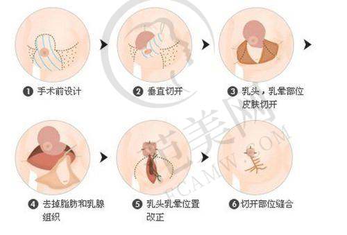 南京维多利亚整形美容乳头缩小10000元起怎么样预约