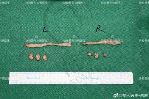 南京维多利亚整形美容乳头缩小10000元起的整体情况如何