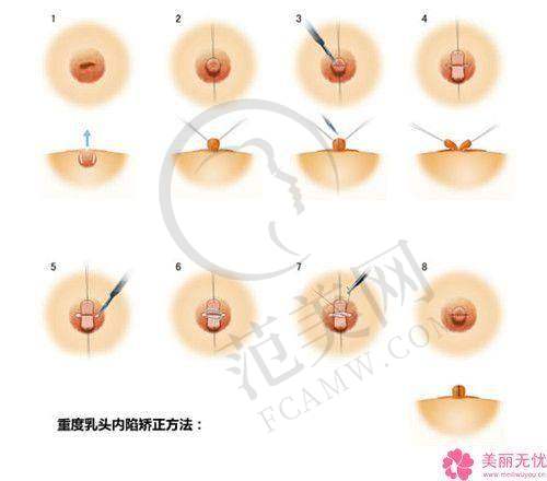 南京维多利亚整形美容乳头缩小10000元起划算吗