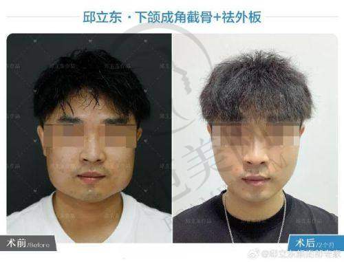 上海九院颧骨颧弓磨骨72000元起怎么预约