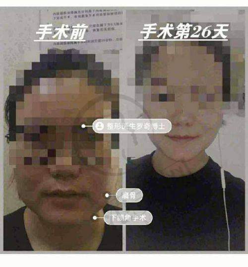 上海九院颧骨颧弓磨骨72000元起顾客实例