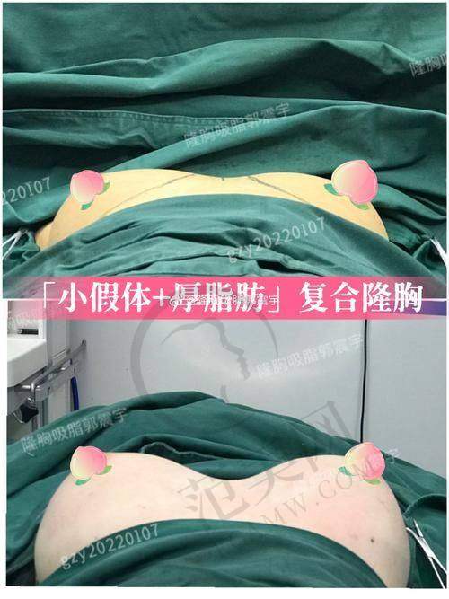三、分层注射：美波婷不伤身的丰胸秘诀