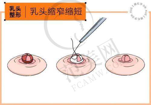 合肥翡奢乳晕缩小8000元起手术前后注意事项