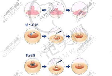 合肥翡奢乳晕缩小8000元起优势详解