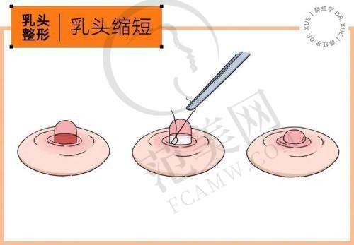 合肥翡奢乳晕缩小8000元起划算吗