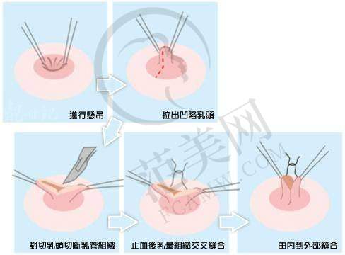 合肥翡奢乳晕缩小8000元起相关整形项目价格对比