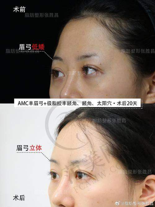 西安思悦adm假体垫眉弓25000元起，ADM材料成效好维持久，速来预约体验！ 