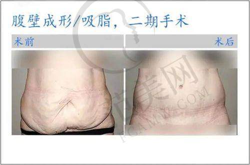 武汉艺星徐国建做胸部悬吊的患者术后满意度高吗？