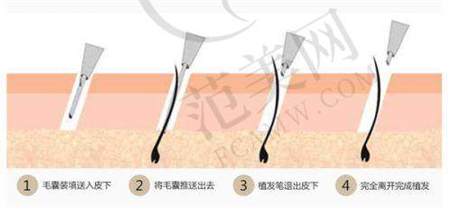 成都恒美植发医院项目特色