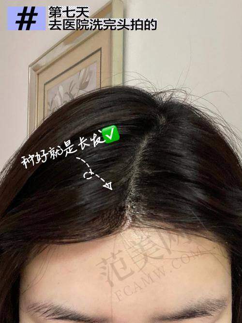 李美瑛医生的植发技术优势