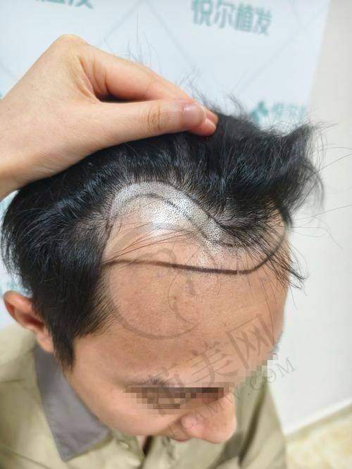 成都恒美植发医院怎么样，口碑评价如何？