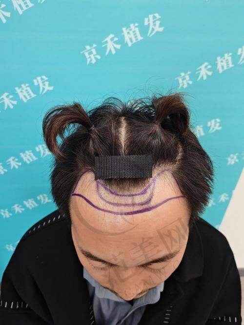 成都恒美植发医院价格表
