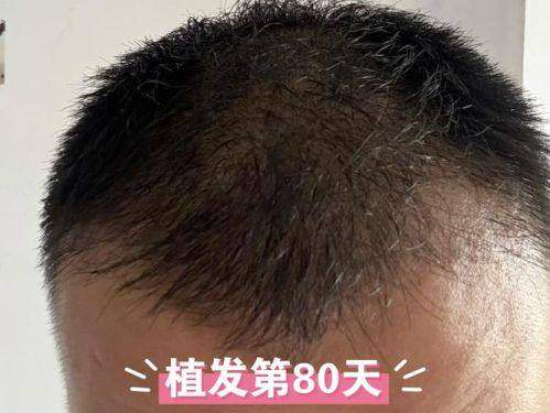 成都恒美植发医院口碑好不好？附真实患者口碑评价