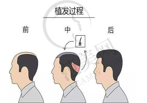 北京瑞丽诗植发医院口碑好不好？附真实患者口碑评价