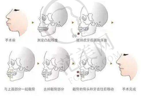 冯少清双眼皮成效咋样?真实实例来见证