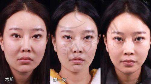 找冯少清做双眼皮，这些陷阱要躲开