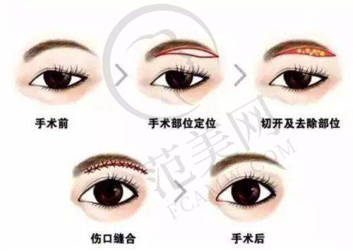 文丰做鼻子优缺点测评：成效自然持久，保持时间长