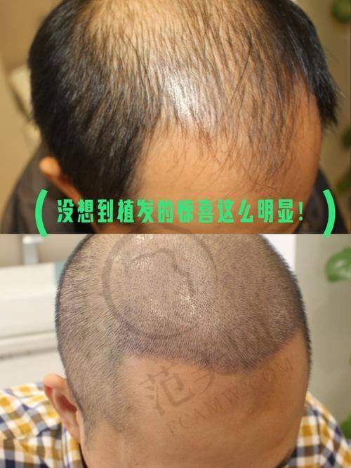呼和浩特瑞丽诗植发医院价格表